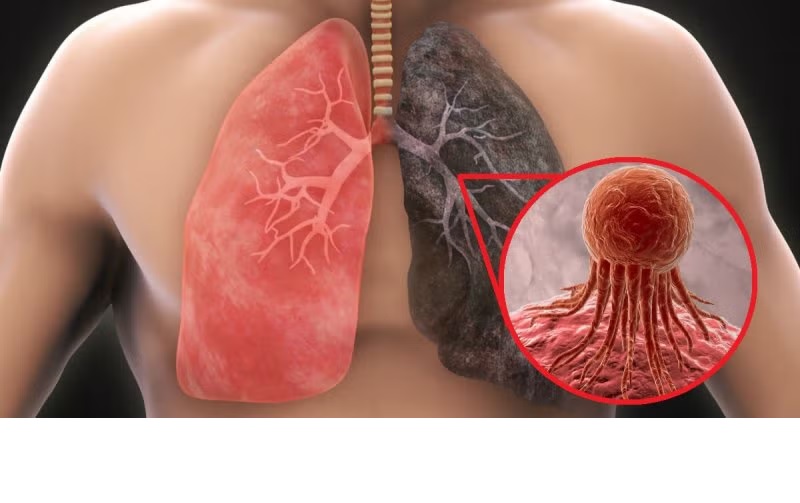 Desarrollos en la terapia de radiación para el cáncer de pulmón